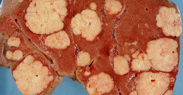 Cancer Tumors - Photo from Wikimedia Commons